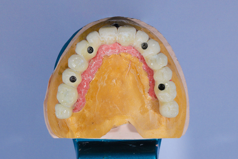 Ideal Candidates For All On   Implants