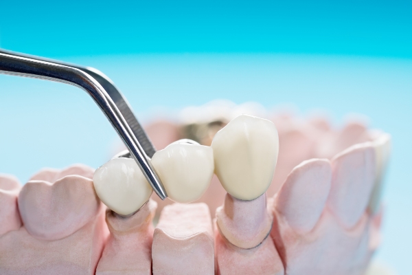 Dental Bridge: Exploring Your Options